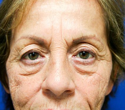 before-eyelid-surgery-blepharoplasty