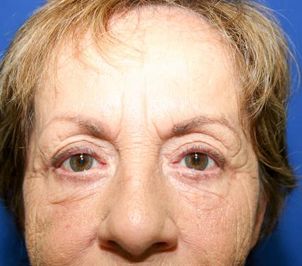 BLEPHAROPLASTY - EYELID SURGERY 137