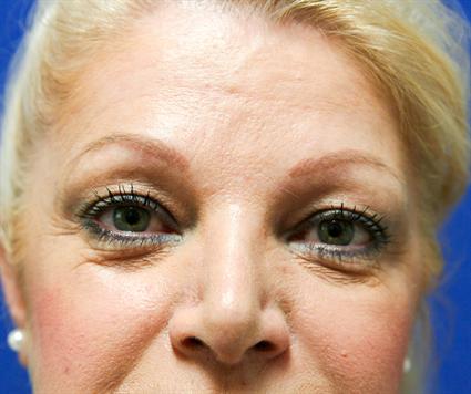 eyelid-surgery-blepharoplasty-before-female