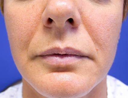 before-lip-procedure
