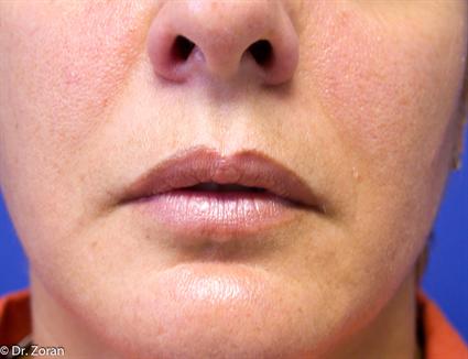 SOFT TISSUE FILLERS OF LIPS 139