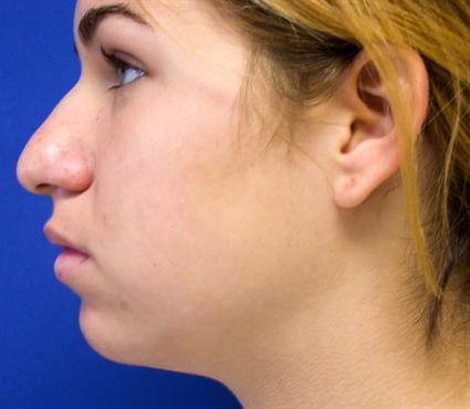before female nose surgery