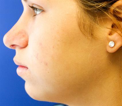 RHINOPLASTY - NOSE SURGERY 140
