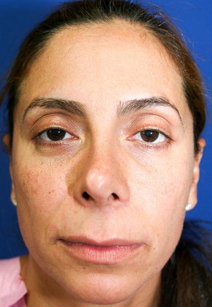 before corrective nose surgery