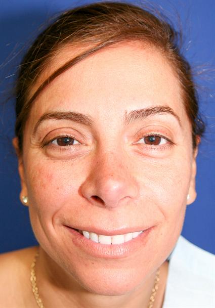 CORRECTIVE NOSE SURGERY MULTI NOSE SURGERIES 141