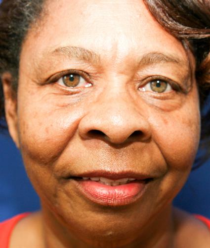 before- eyelid surgery
