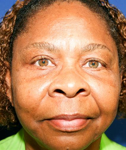 BLEPHAROPLASTY - EYELID SURGERY 142