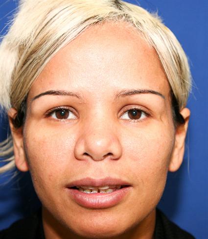 before ethnic rhinoplasty
