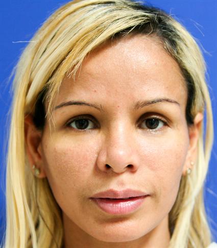 ETHNIC RHINOPLASTY - NOSE SURGERY 149