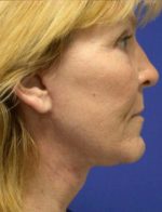 FACE LIFT AND NECK LIFT WITH FAT GRAFTING 172