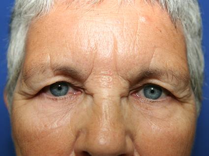 UPPER BLEPHAROPLASTY - EYELID-before