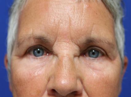UPPER BLEPHAROPLASTY - EYELID 193