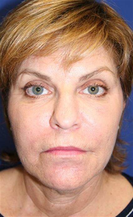 FACIAL FAT GRAFTS CASE 195