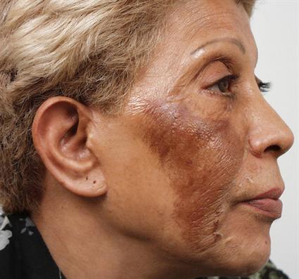 chemical-peels-before