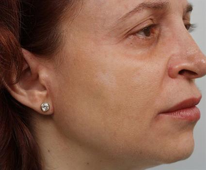 CHEMICAL PEELS BLUE PEEL 205