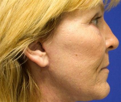 FACIAL FAT GRAFTS 206