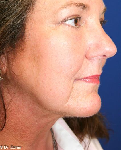 NECK LIPECTOMY - NECK COUNTOURING 21