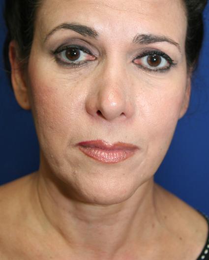 before-neck-lift