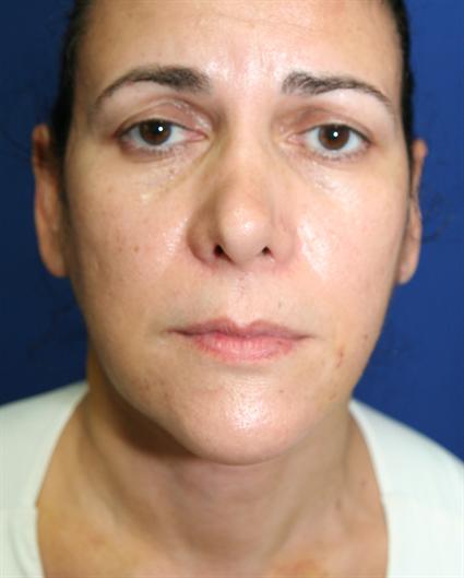 NECK LIFT 220