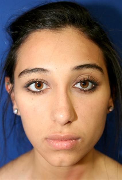 facial-fat-graft-before