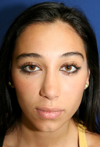 FACIAL FAT GRAFTS 221