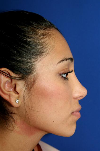RHINOPLASTY - NOSE SURGERY 122