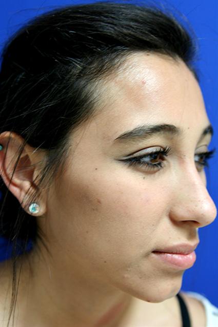 THE ETHNIC RHINOPLASTY DIARY: POST-OP PART 2