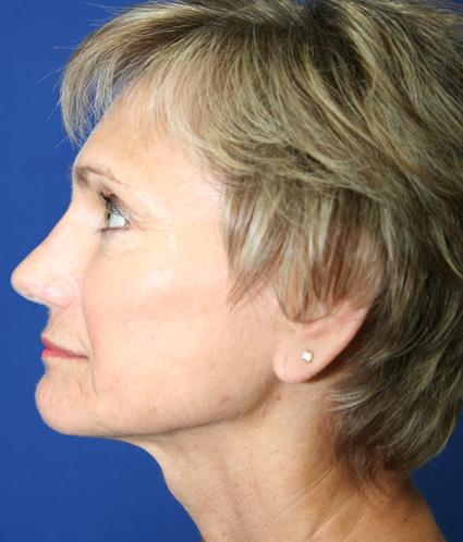 before-face-lift-and-neck-lift