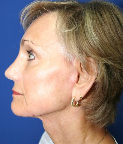 FACE LIFT AND NECK LIFT 222