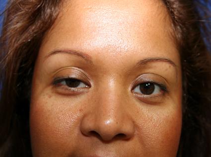 eyelid-ptosis-repair-before