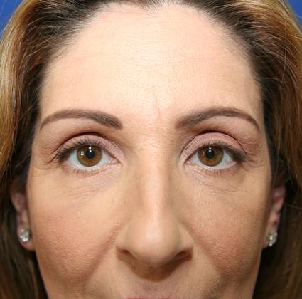 FACIAL FAT GRAFTS 227