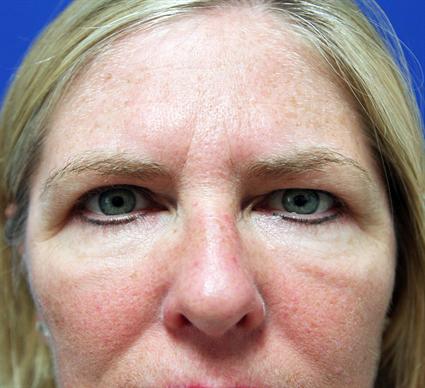 BLEPHAROPLASTY - EYELID SURGERY 228