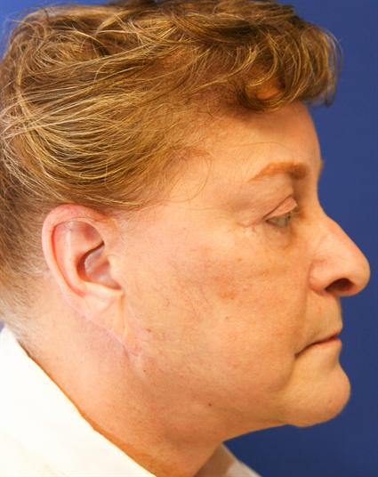 before facial-neck lift
