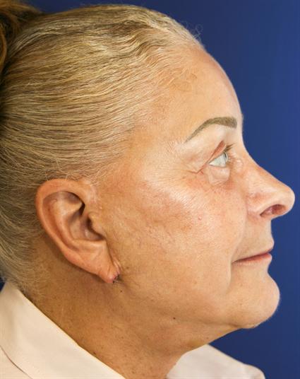 FACE LIFT AND NECK LIFT 23
