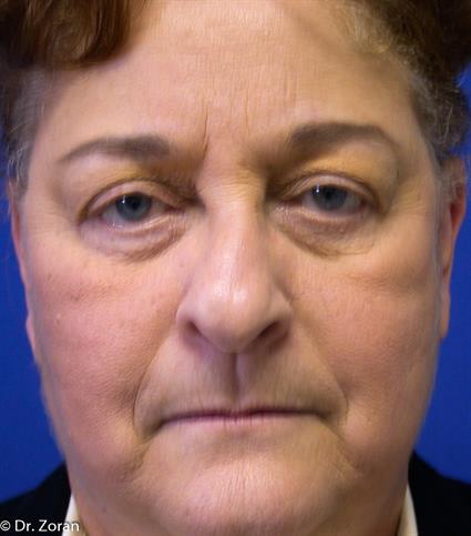 before eyelid surgery