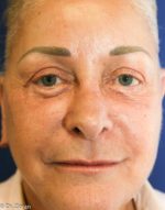 FACE LIFT AND NECK LIFT 23