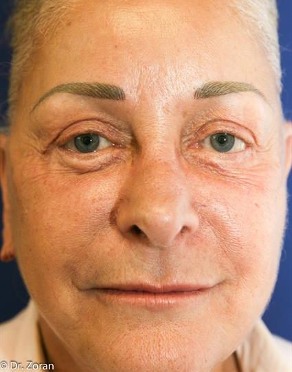 FACE LIFT AND NECK LIFT 23