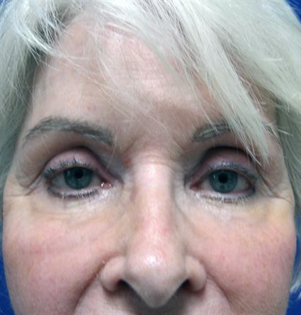facial-fat-graft-before
