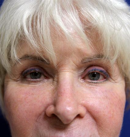 FACIAL FAT GRAFTS 231