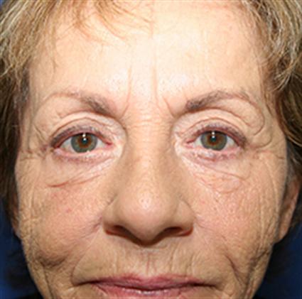 FACIAL FAT GRAFTS 232