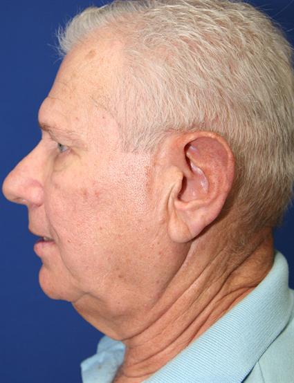before-male-face-lift-and-neck-lift