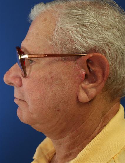 FACE LIFT AND NECK LIFT 234