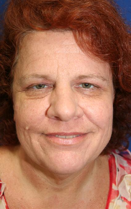 before-facial-rejuvenation
