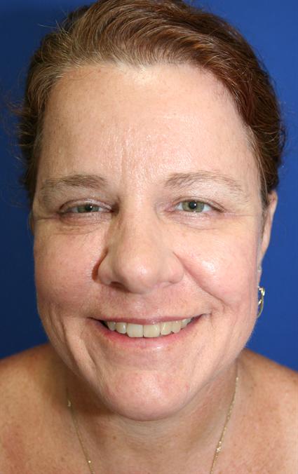 FACE LIFT AND NECK LIFT - BLEPHAROPLASTY - EYELID SURGERY - FACIAL FAT GRAFTS - CHEMICAL PEELS 236
