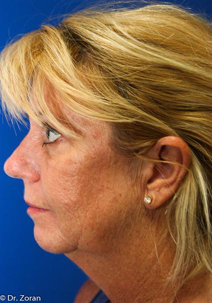 before-face-lift-and-neck-lift