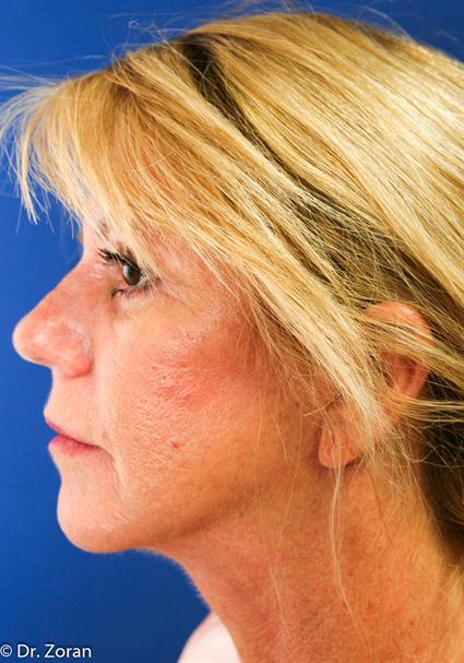 FACE LIFT AND NECK LIFT 237