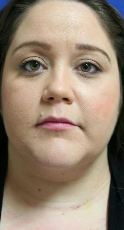 NECK LIPOSUCTION - LIPCETOMY 238