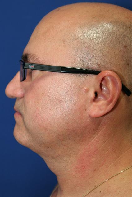 NECK LIPOSUCTION - LIPCETOMY 239