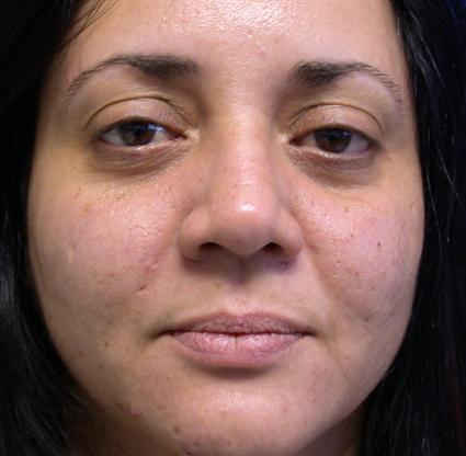 before corrective nose surgery