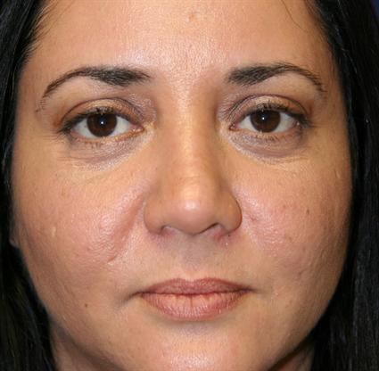 CORRECTIVE NOSE SURGERY CASE 241